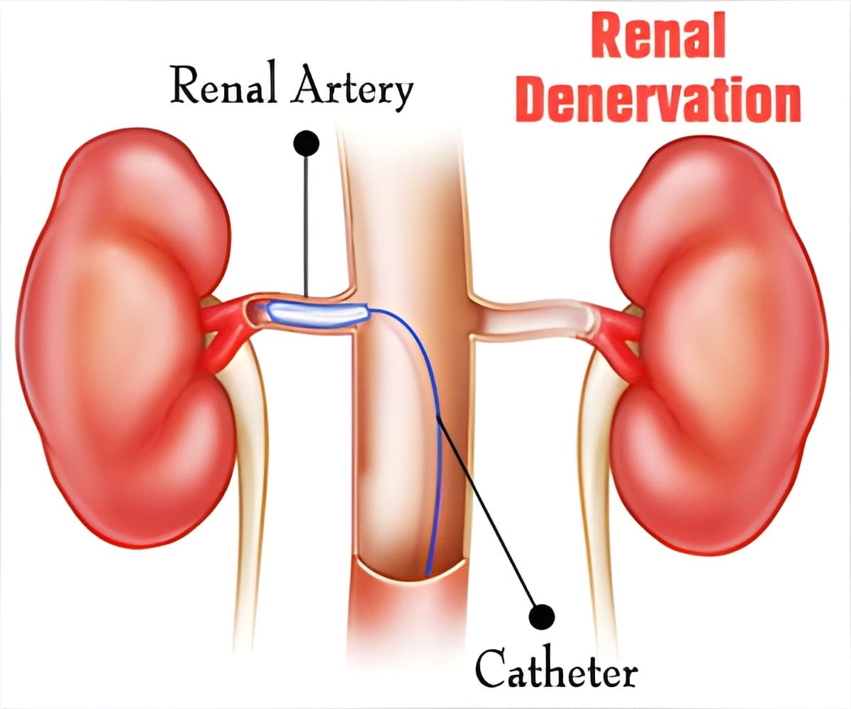 Renal Denervation - A Breakthrough in Hypertension Treatment
