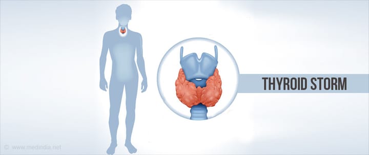 Thyroid Storm - A Rare but Life-Threatening Emergency