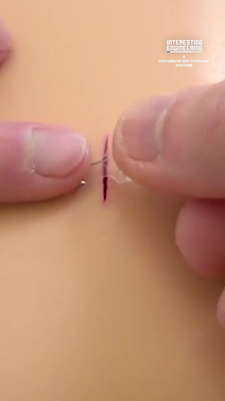 Revolutionizing Wound Care: microMend Skin Closures