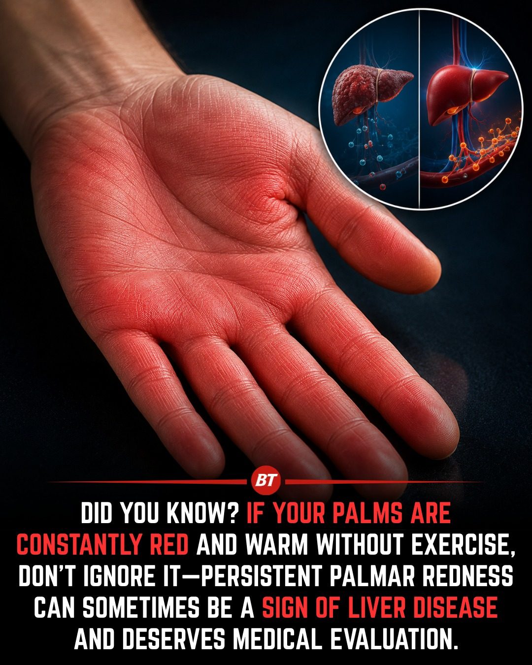 Palmar Redness: A Potential Sign of Liver Disease