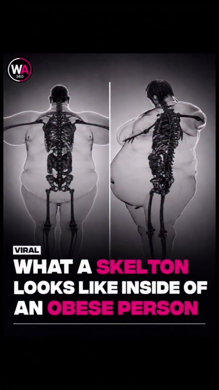 Understanding Obesity's Impact on Bone Structure