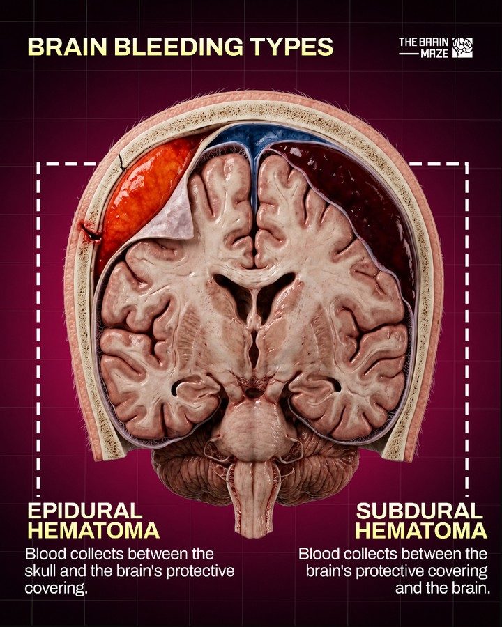 Learn About Epidural and Subdural Brain Bleeding
