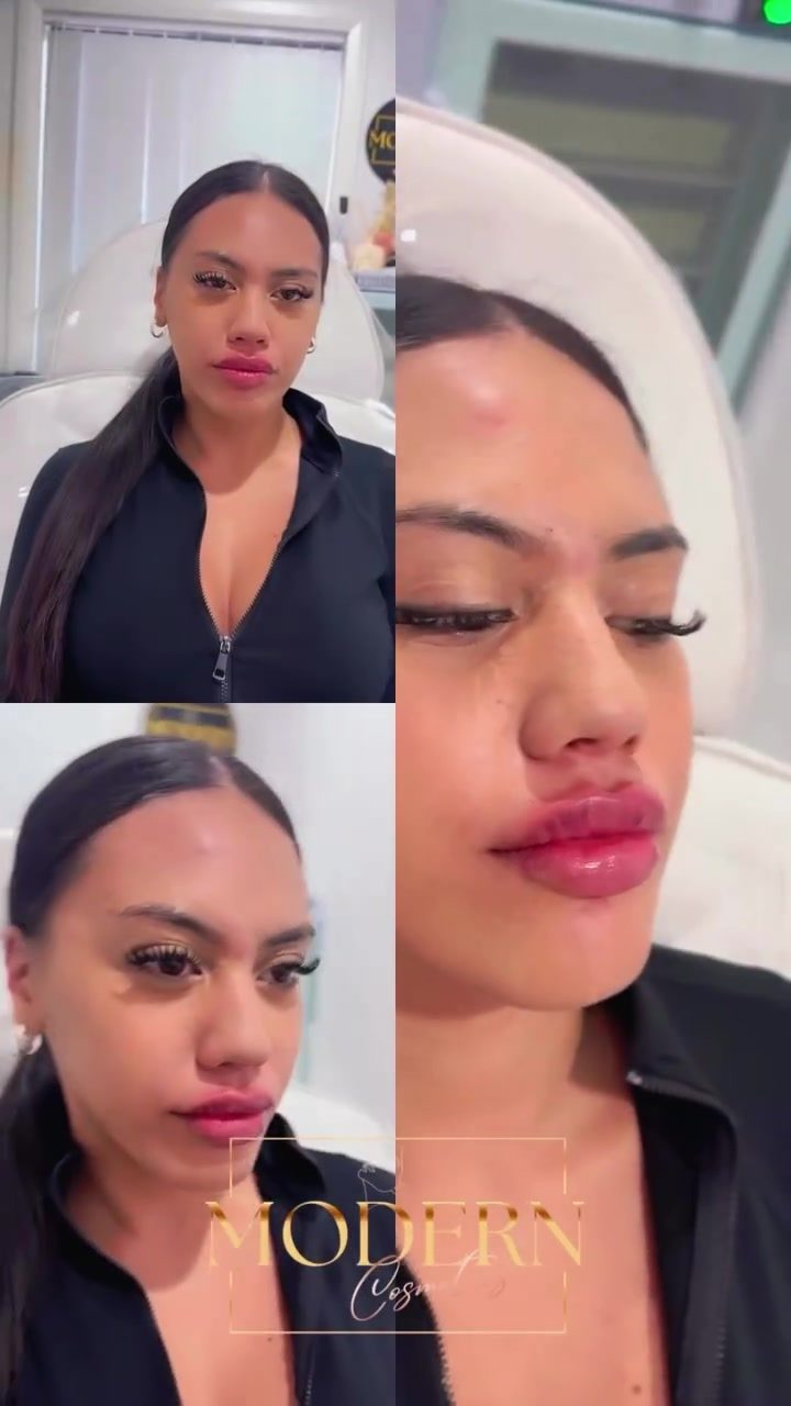 Modern Cosmetics: Personalized Lip Filler Consultations