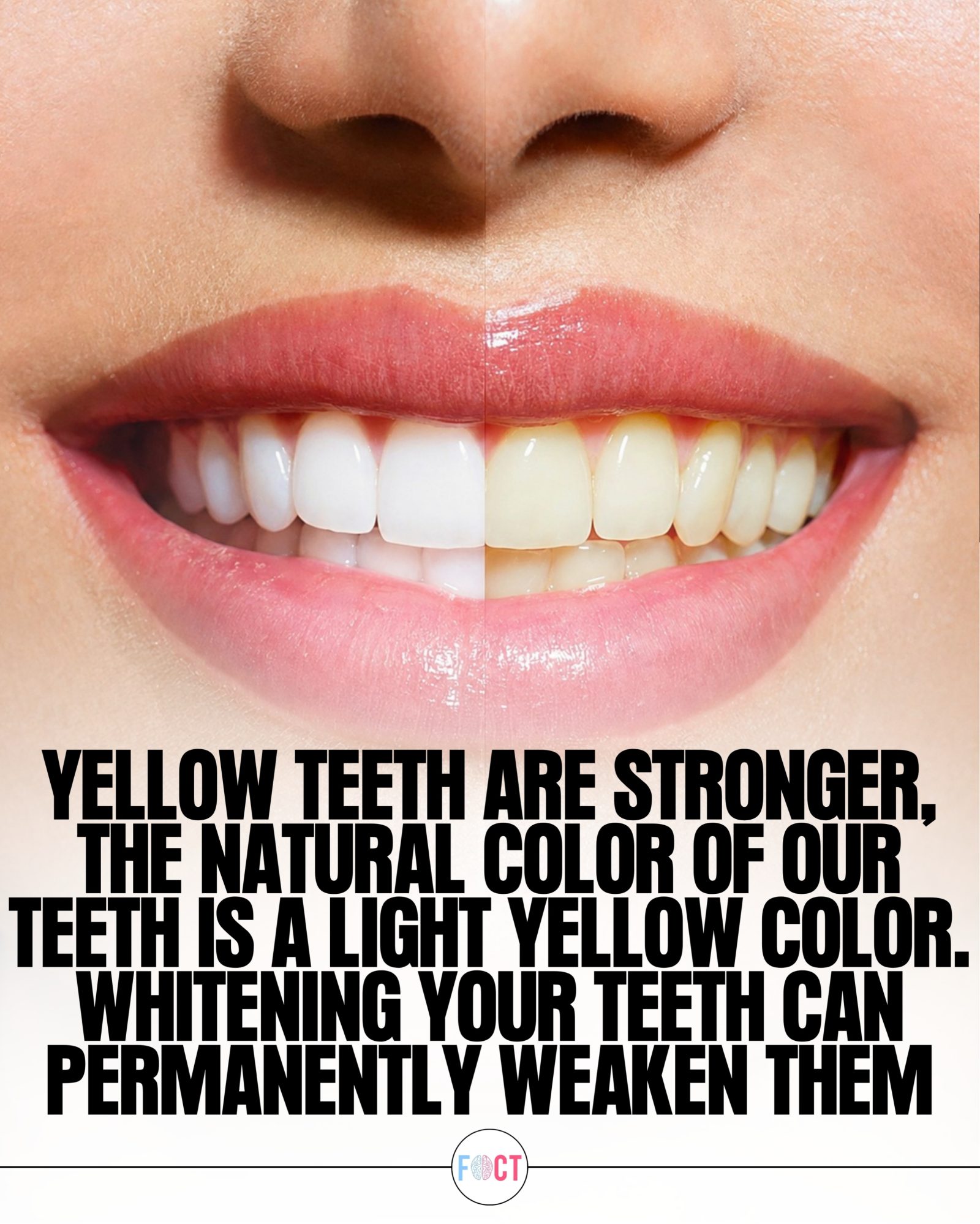 The Truth About Yellow Teeth and Whitening