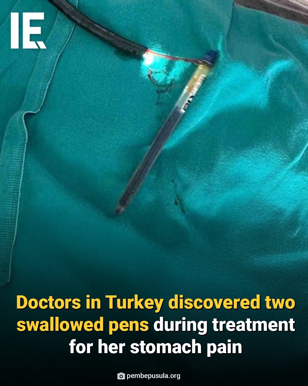 Turkey: OCD Patient Swallows Two Pens, Highlighting Pica Disorder