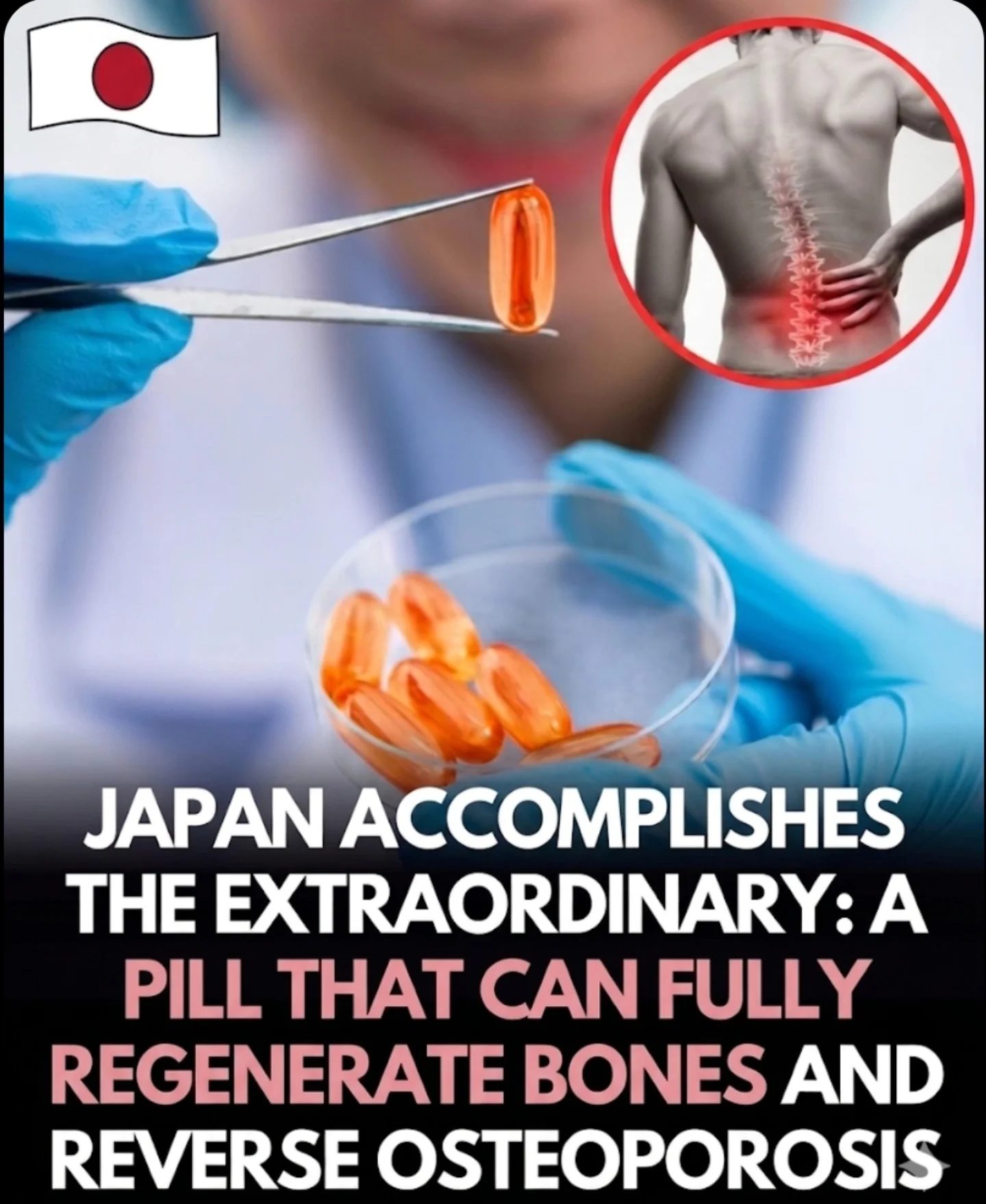 Japan's Revolutionary Pill: Bone Regeneration and Osteoporosis Reversal
