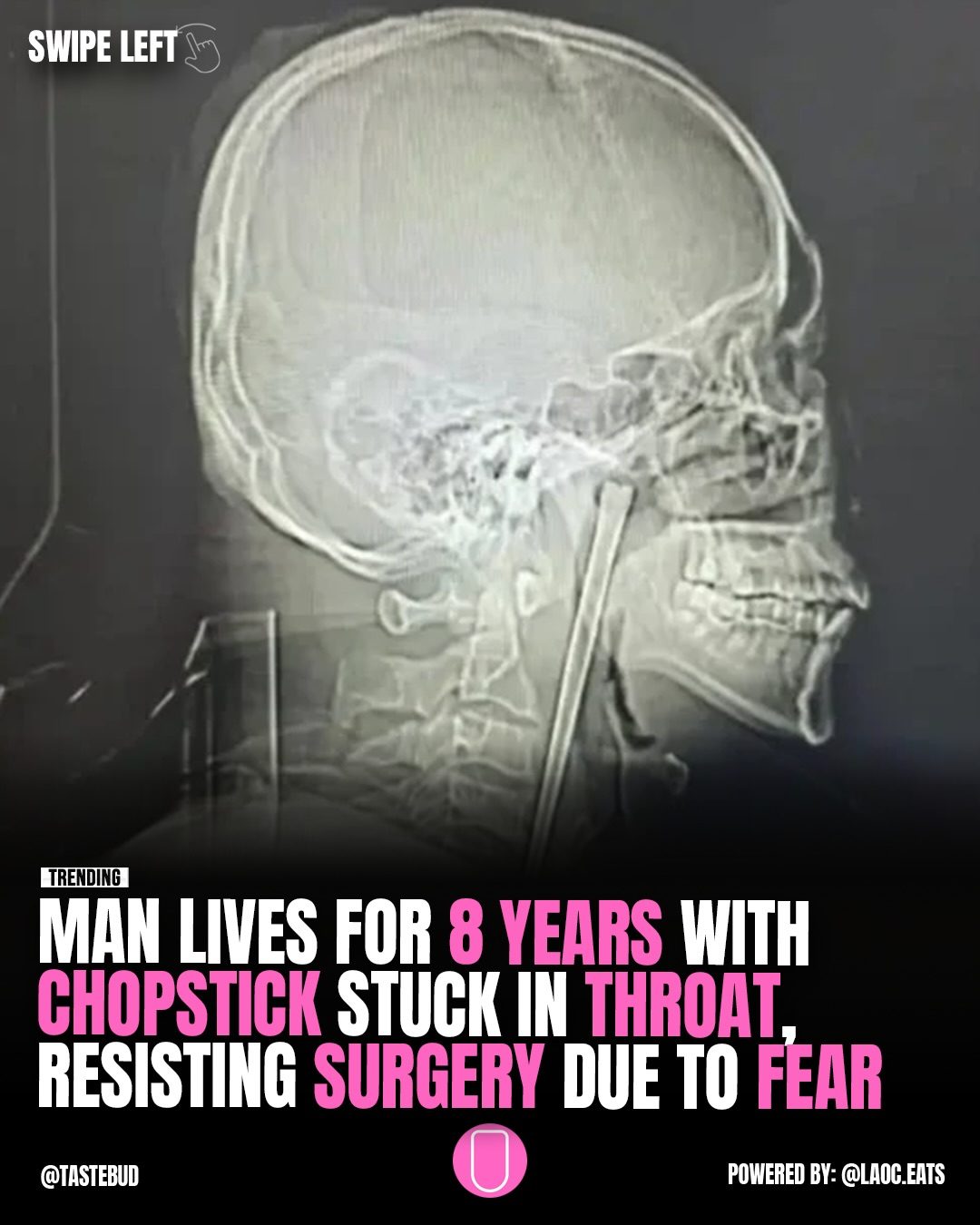 Man Lives Eight Years with Chopstick Stuck in Throat