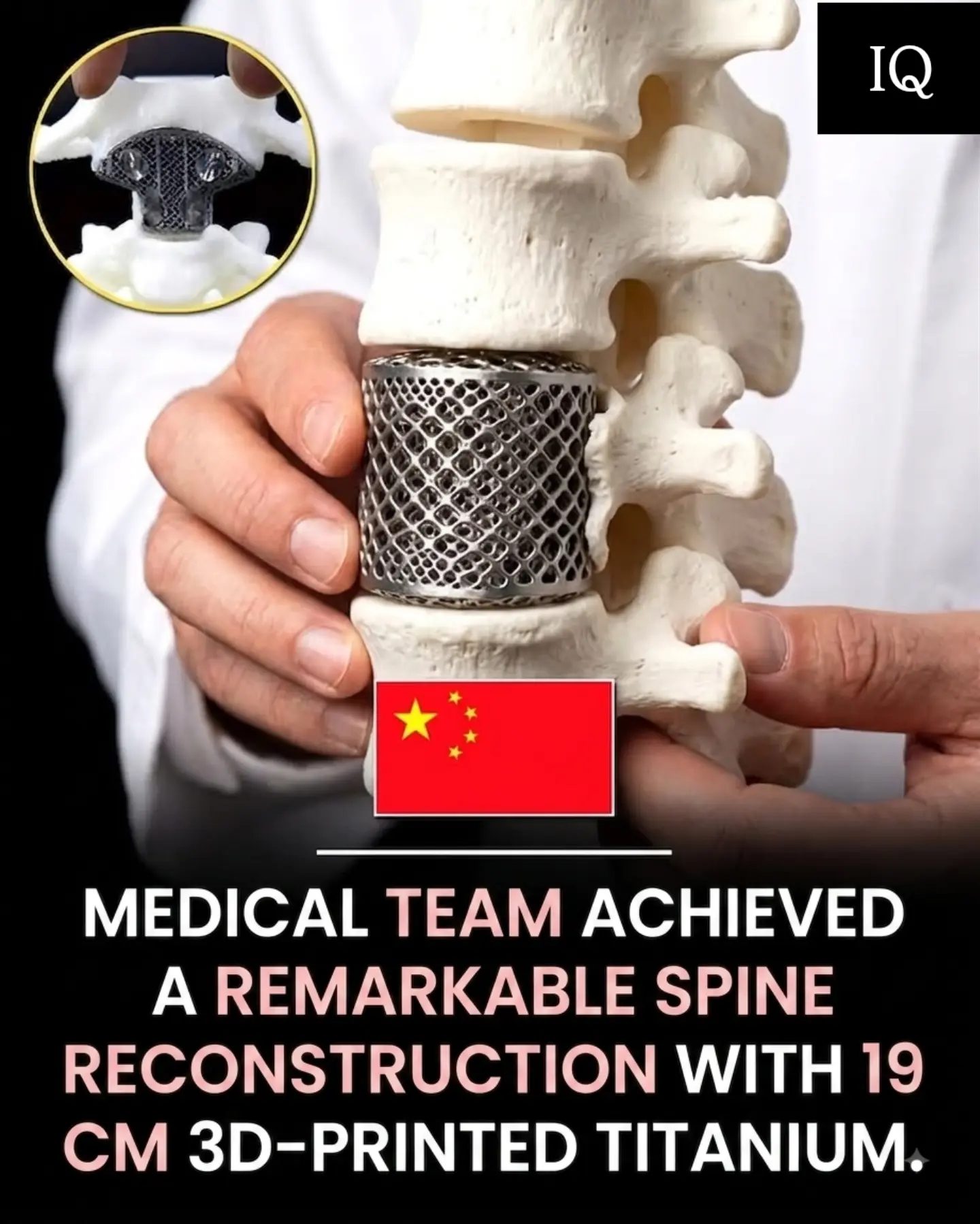 China's Medical Breakthrough: 3D-Printed Titanium Spine