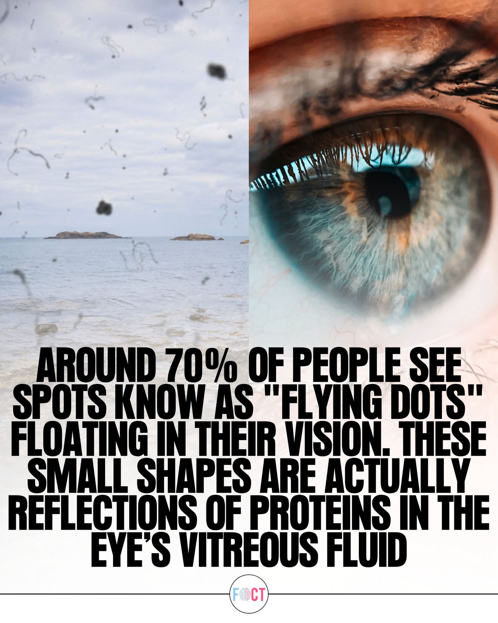 Eye Floaters Explained: Causes and What to Know