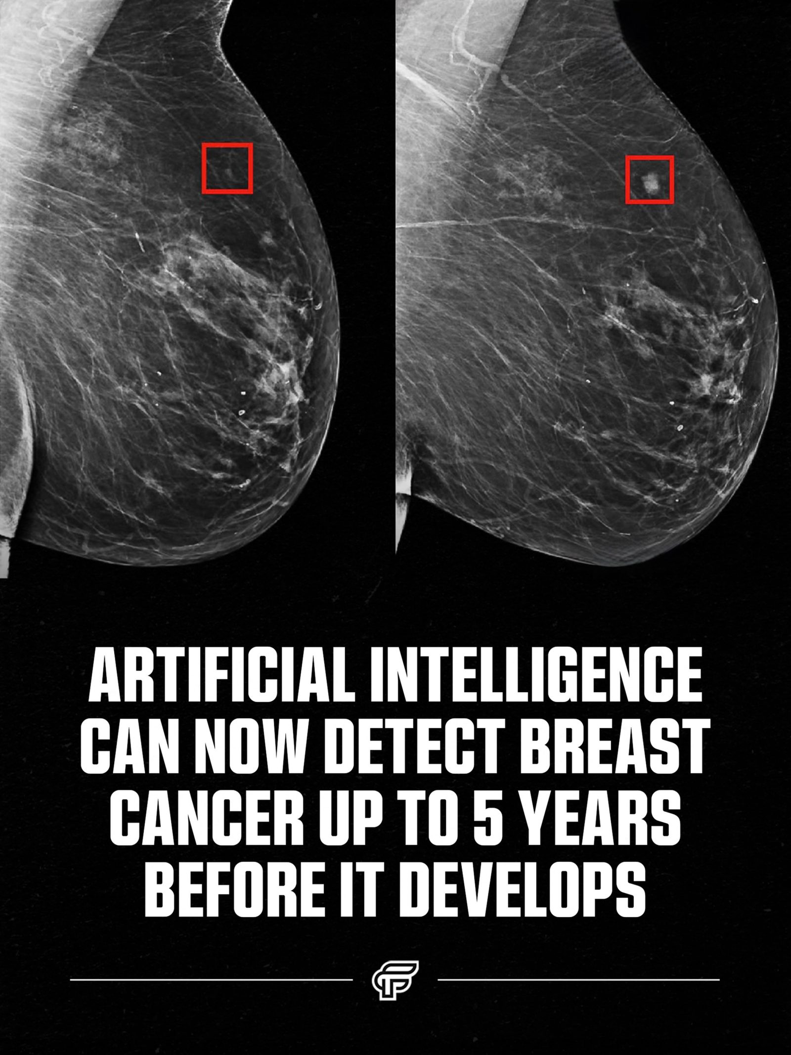**AI in Breast Cancer: Detection Up to 5 Years Early**