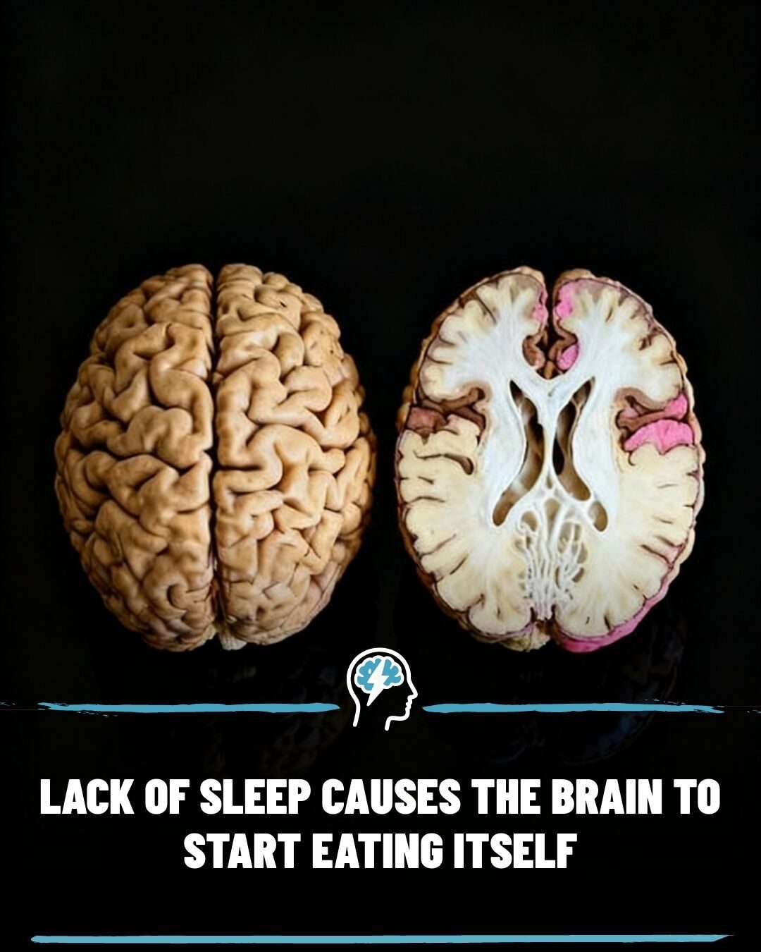 Chronic Sleep Loss: How It Affects Your Brain