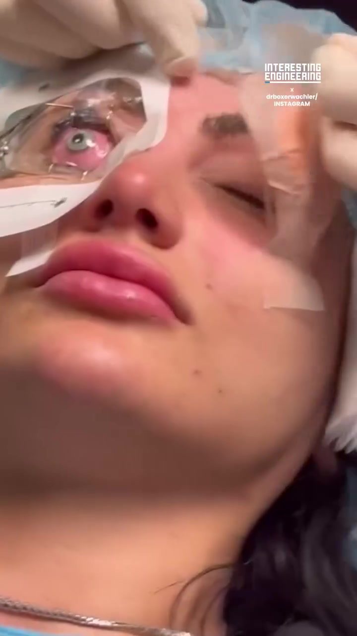 Dr. Boxerwachler's Non-Invasive Eye Color Change Procedure