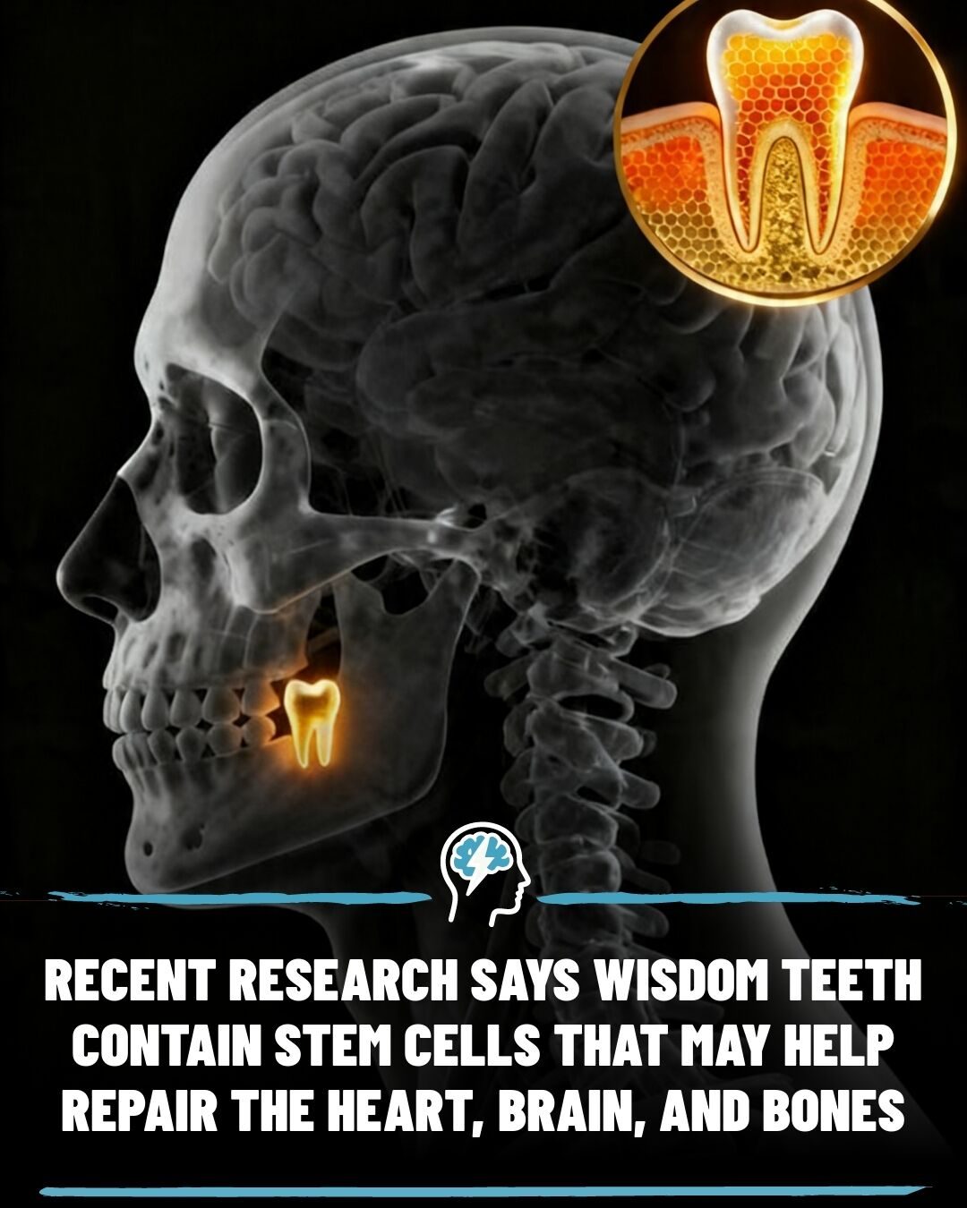 ### Wisdom Teeth: A New Frontier in Stem Cell Research