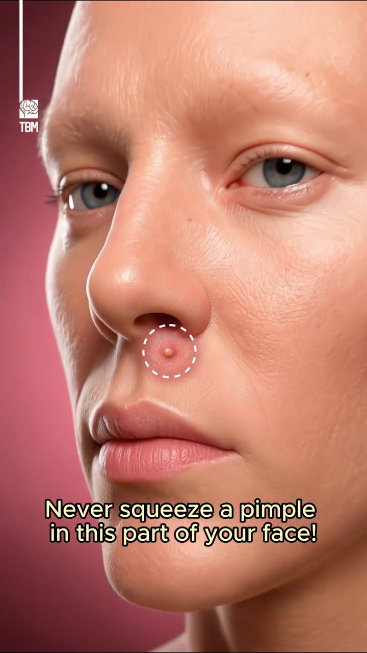Why You Should Never Squeeze Pimples in the Triangle of Death
