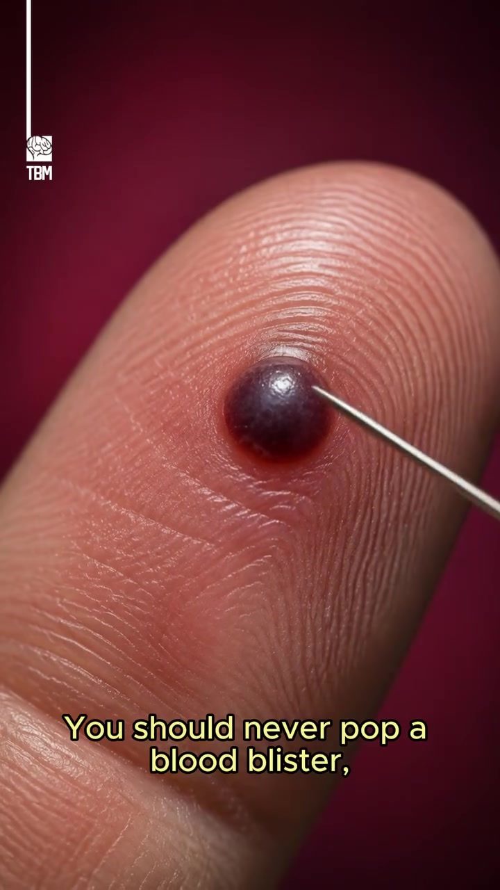 Blisters Are Your Body's Shield: Why Not to Pop Them