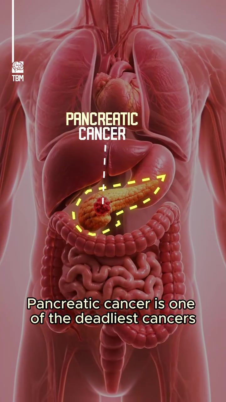 Why Pancreatic Cancer Is So Hard to Detect and Treat