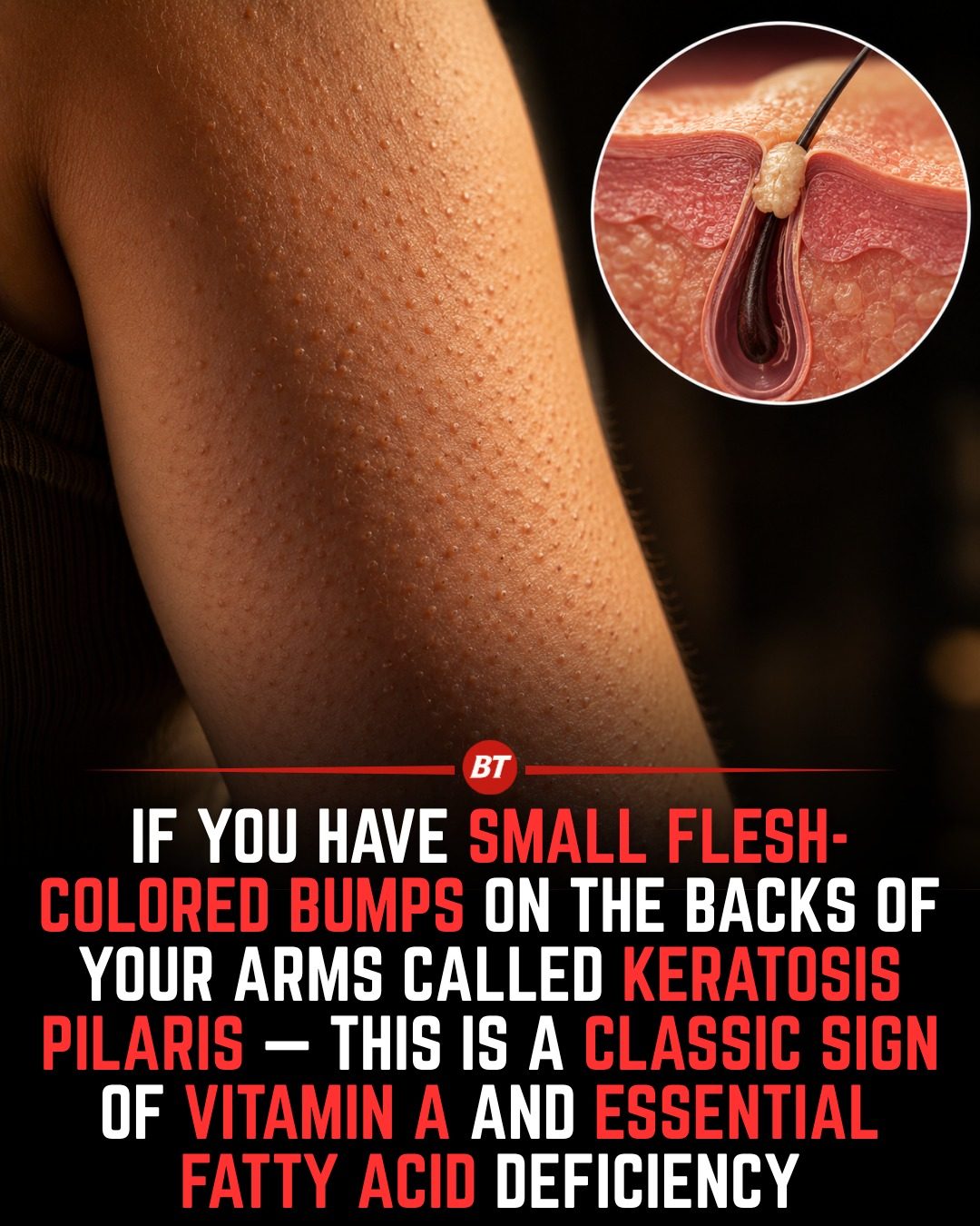 Keratosis Pilaris: Causes and Nutrition Tips for Smoother Skin