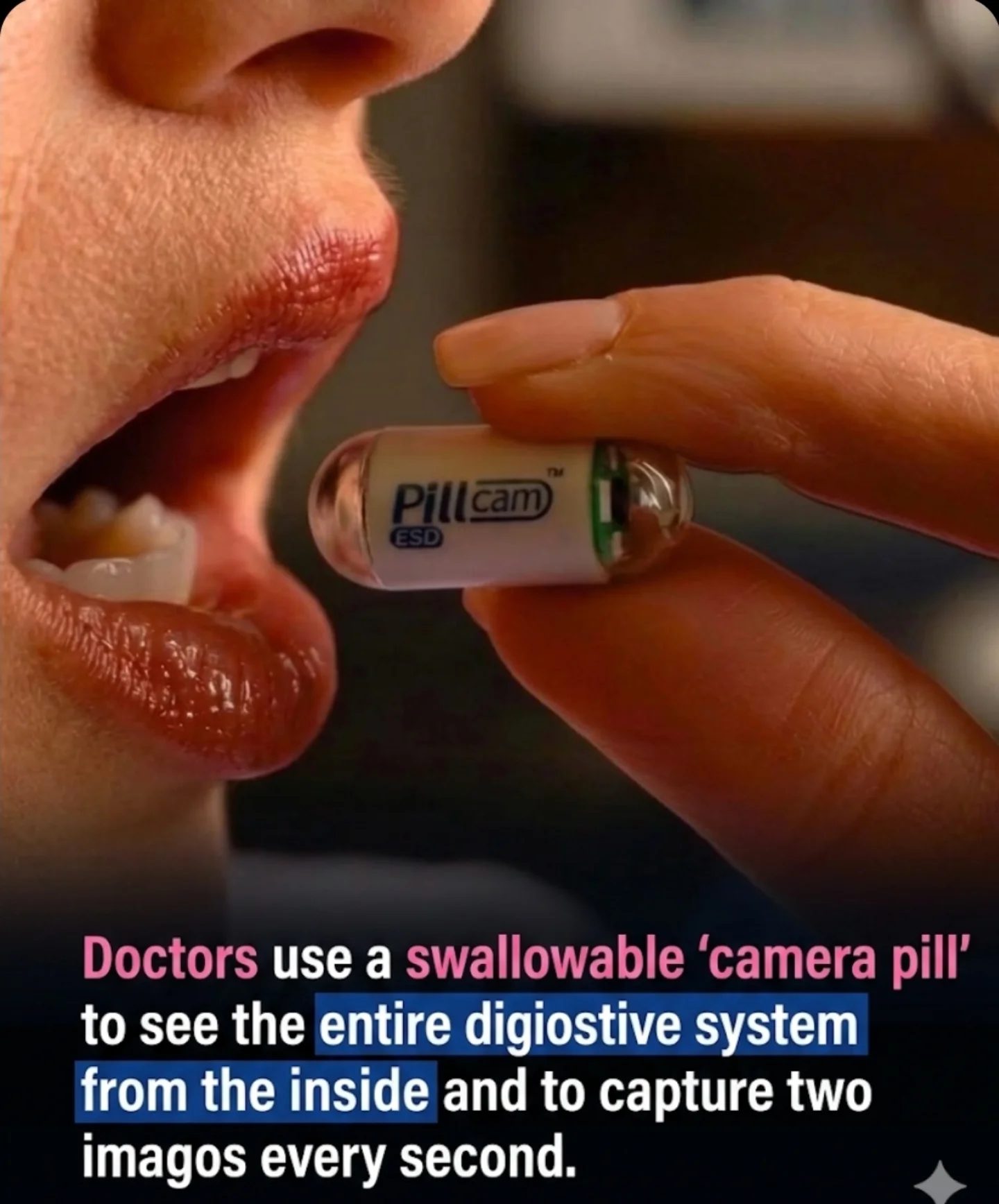 PillCam ESD: Revolutionizing Digestive System Insights