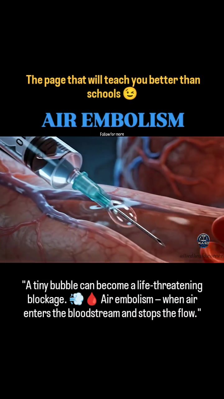 Understanding Air Embolism: A Silent Threat in Healthcare