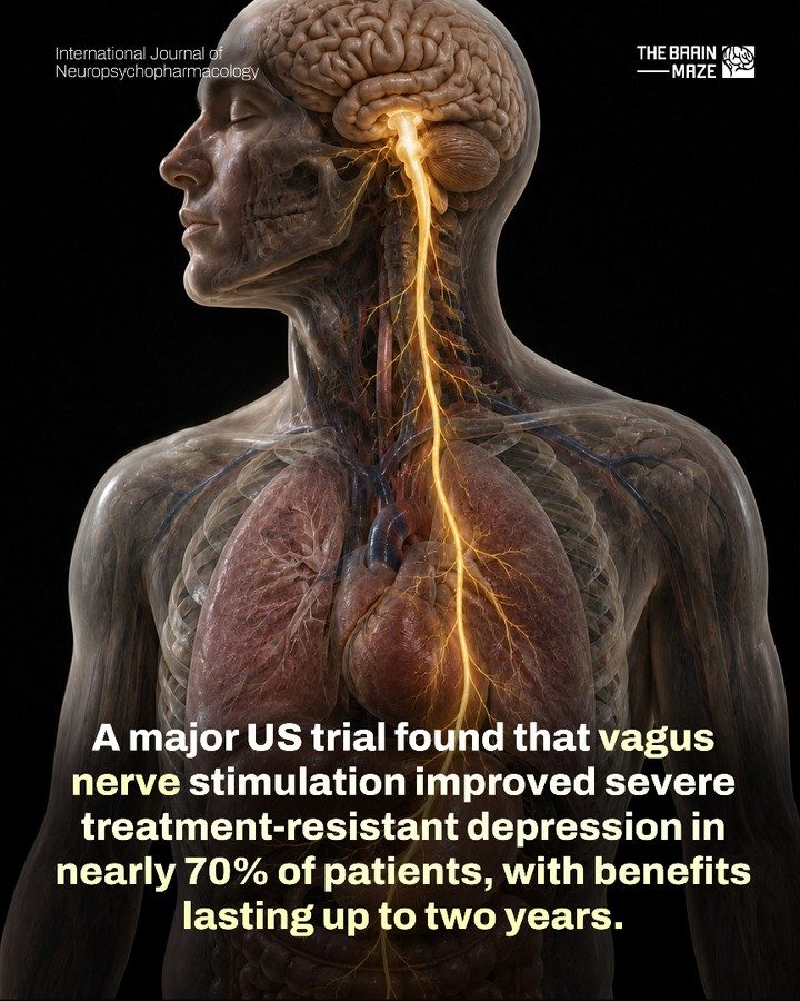 Vagus Nerve Stimulation: Effective for Severe Depression