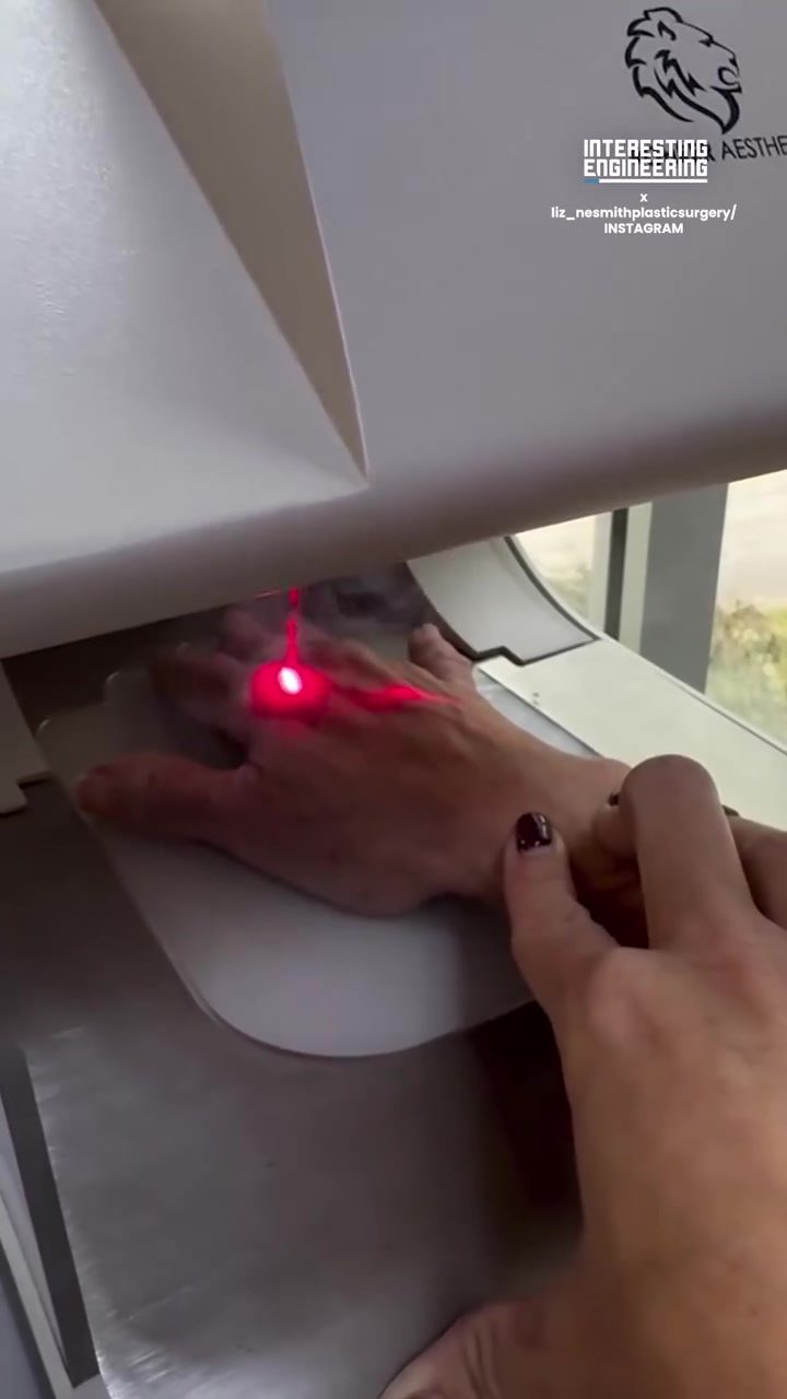 Rohrer Phoenix CO2 Laser: Foot Surgery and Skin Repair