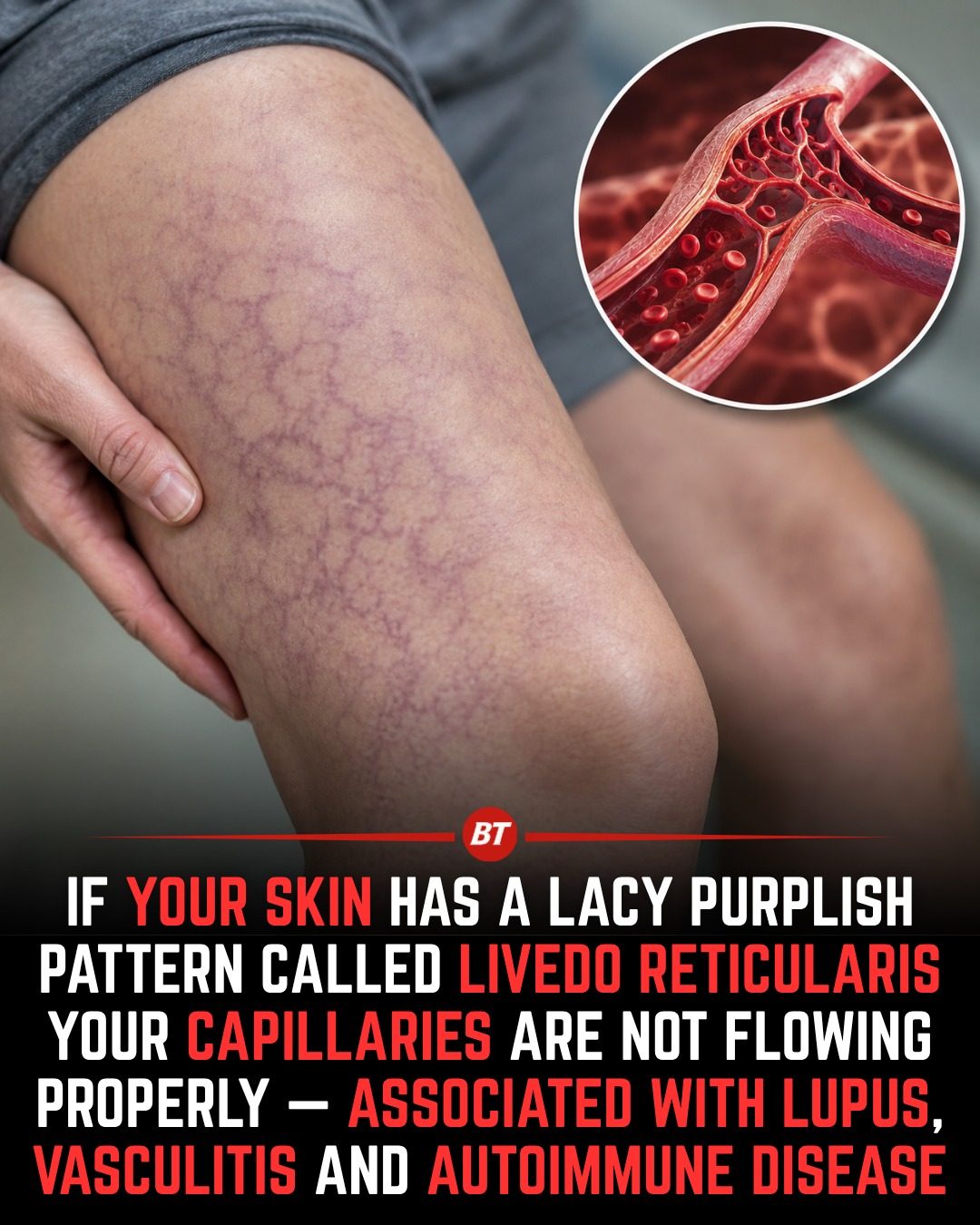Understanding Livedo Reticularis: Causes and Health Implications