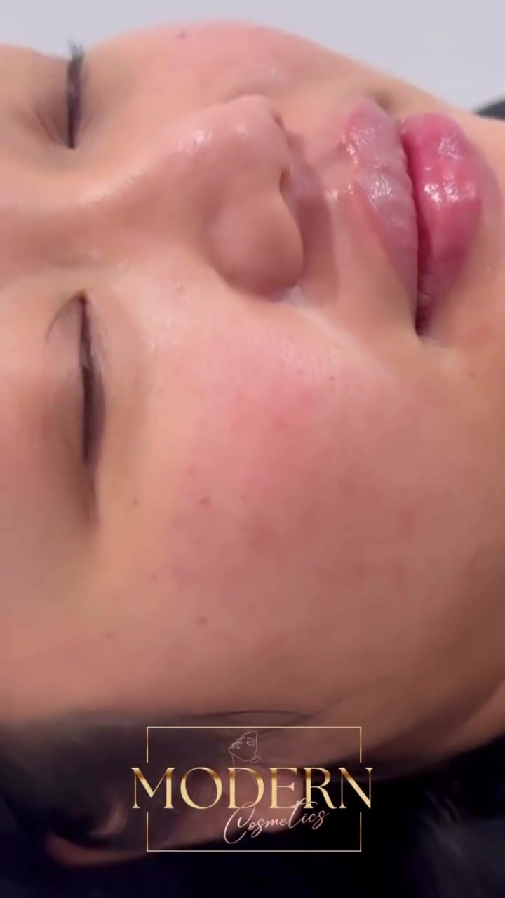 Discover the Personalized Lip Filler Experience at Modern Cosmetics