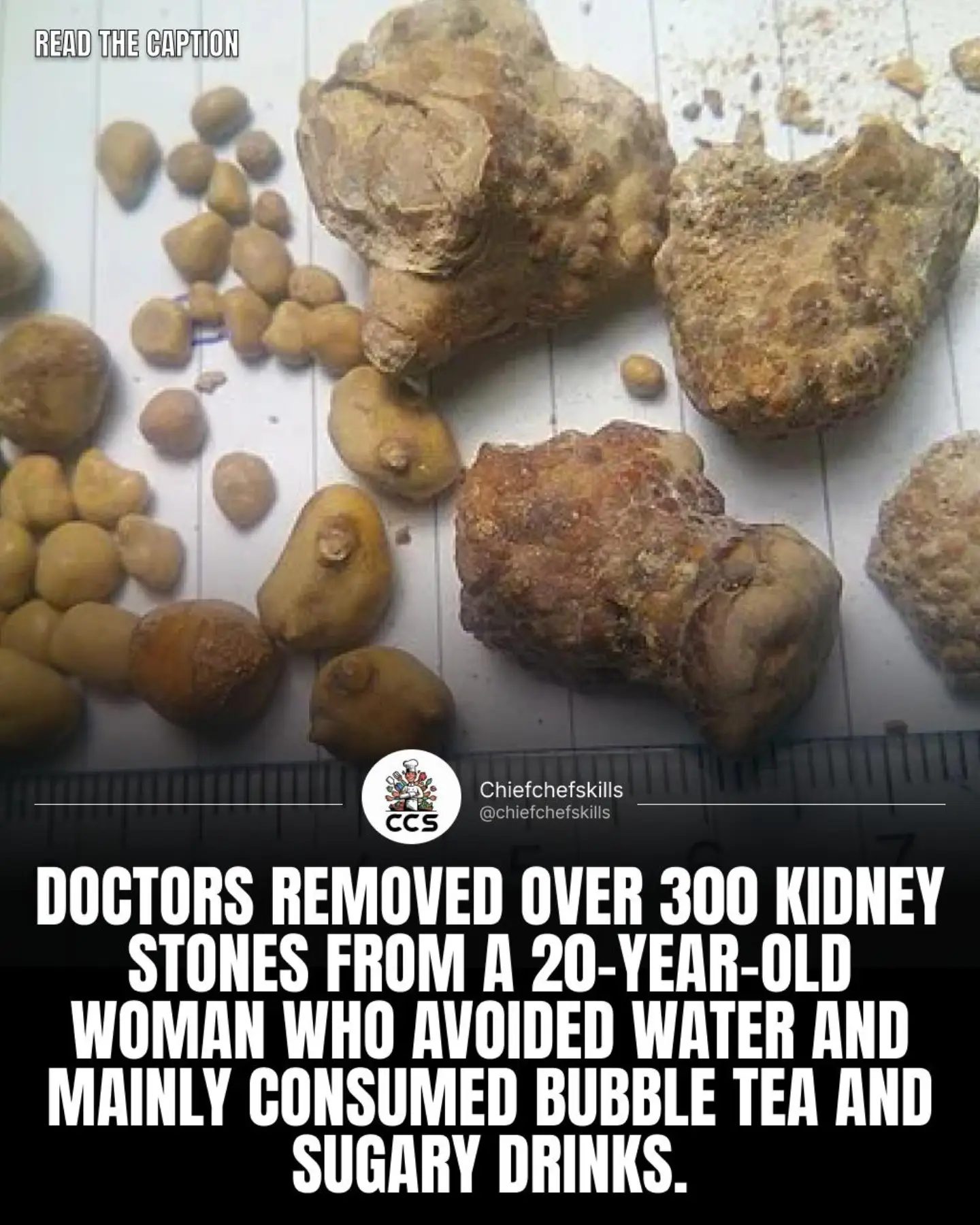 Kidney Stones: The Dangers of Dehydration