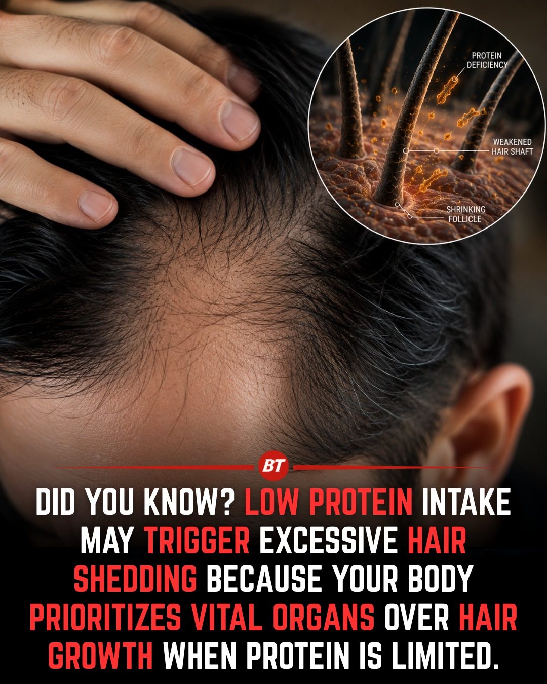 Protein Deficiency and Hair Loss: What You Need to Know