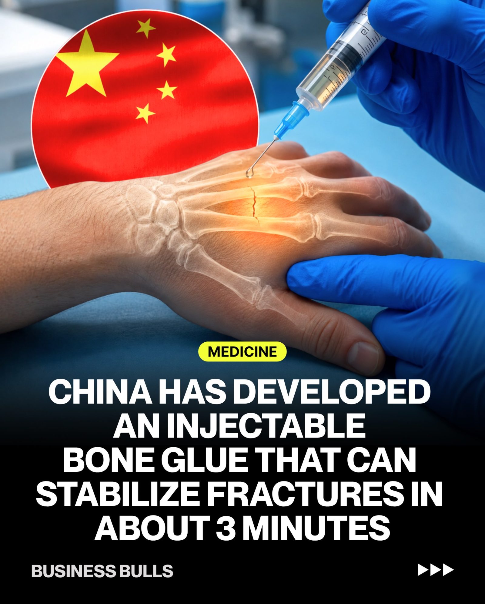 China's New Bone Glue: Stabilizing Fractures in Minutes
