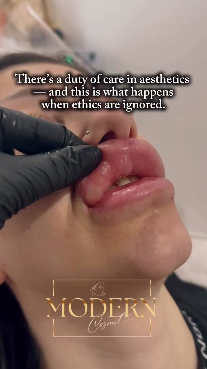 Ethical Lip Filler Procedures: Ensuring Safety and Care
