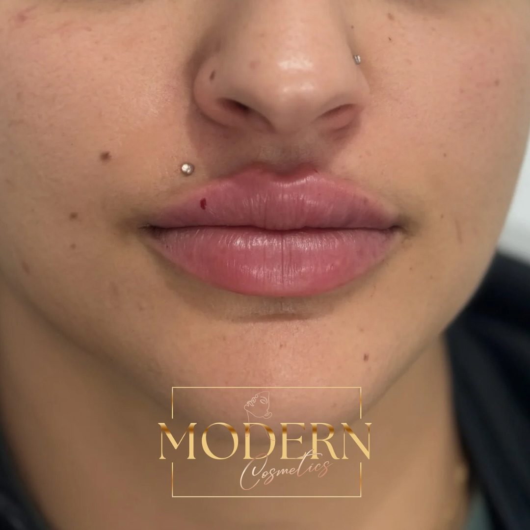 Discover a modern approach to lip fillers at Modern Cosmetics