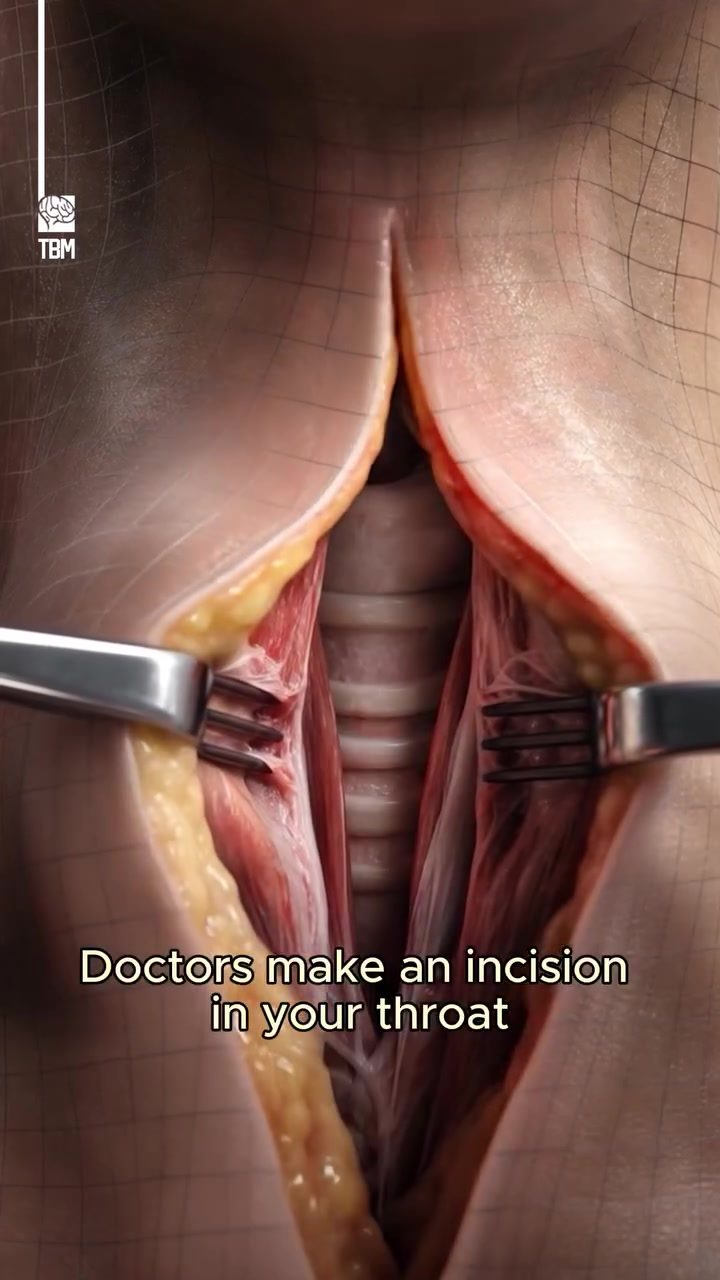Understanding Emergency Tracheostomy: A Life-Saving Procedure