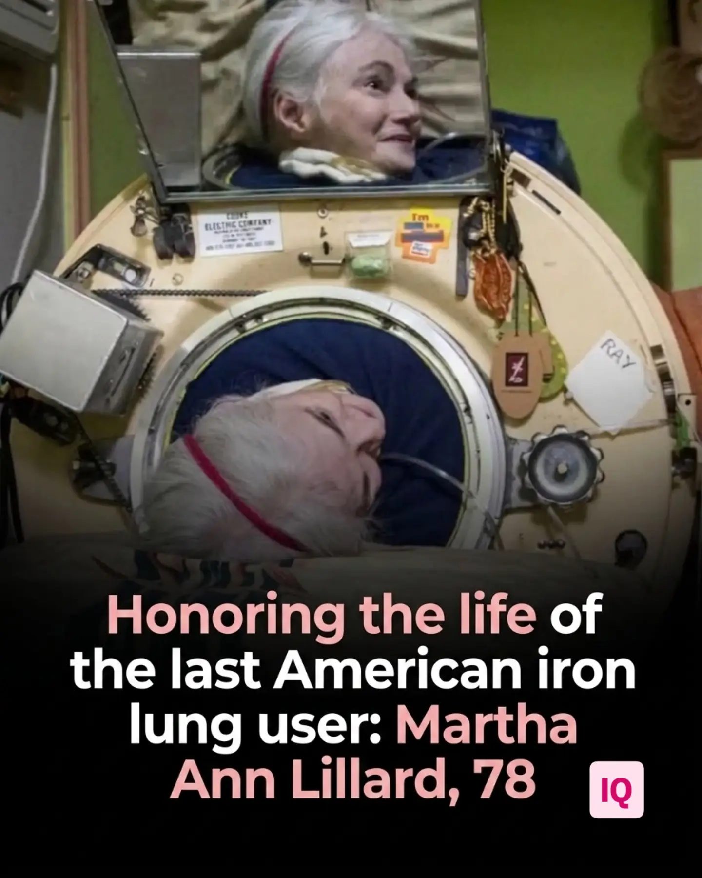Martha Ann Lillard: The Last American Iron Lung User