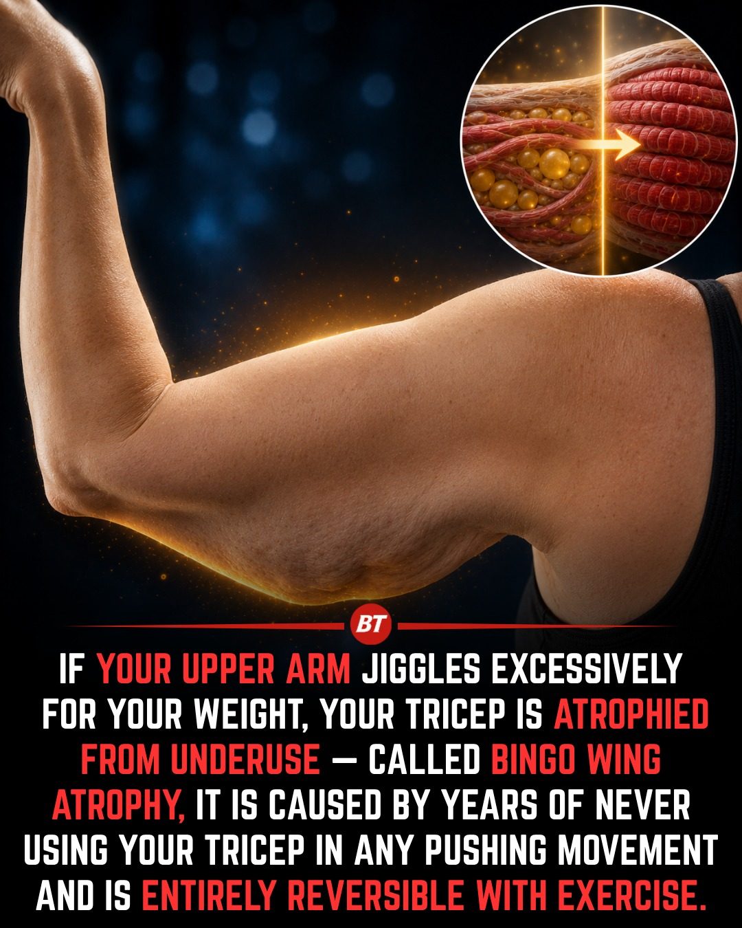 Understanding Bingo Wing Atrophy: Causes and Exercise Solutions